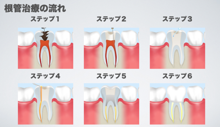 抜髄と感染根管治療について｜きたつじ歯科クリニック｜尼崎市武庫之荘駅の歯科・歯医者