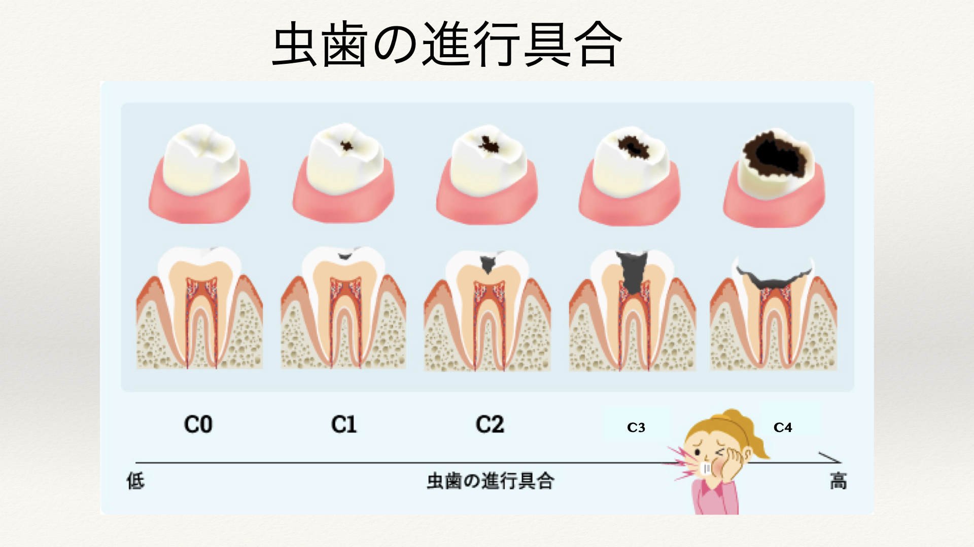 虫歯 進行 度