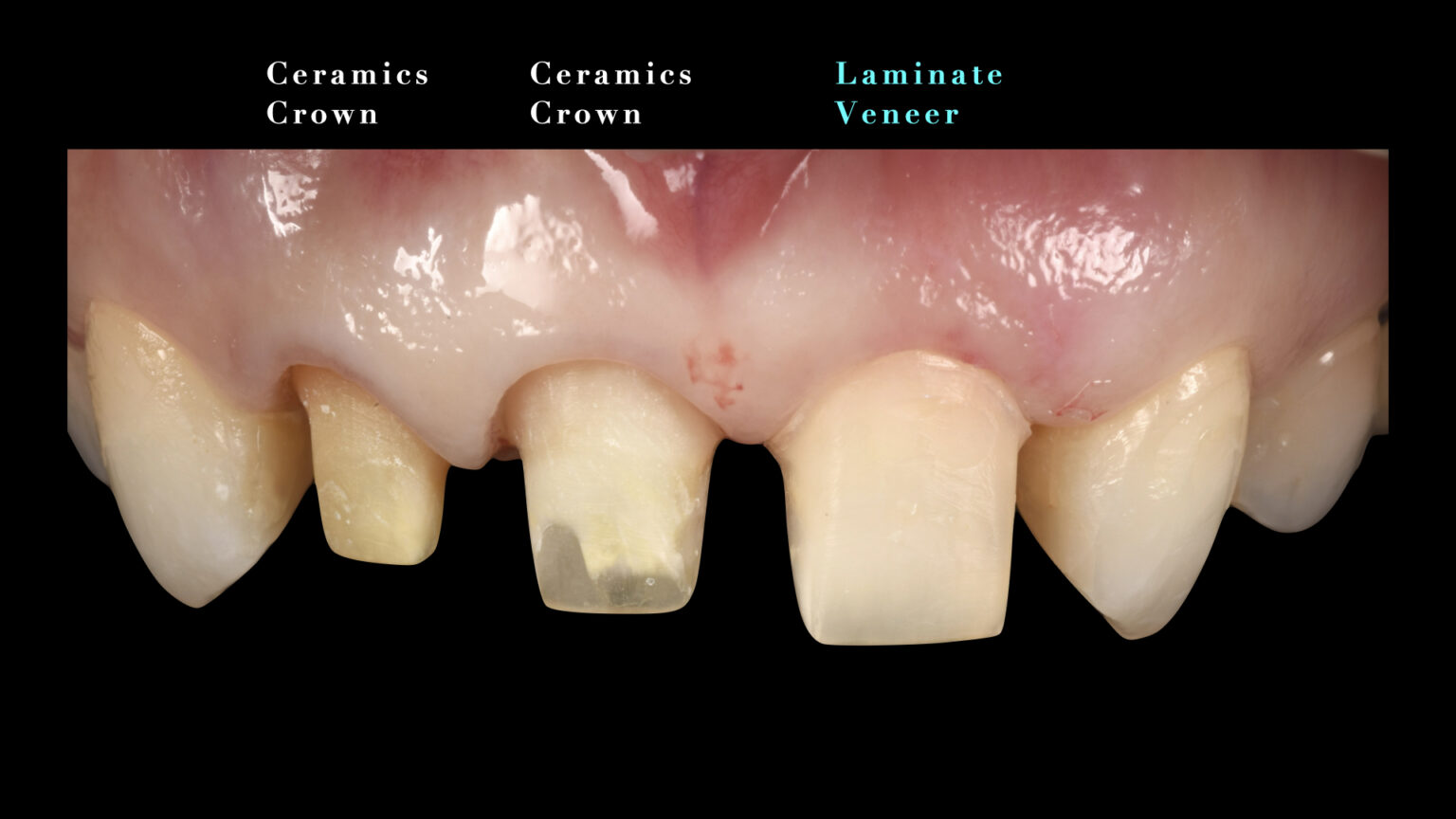 歯の汚れの種類