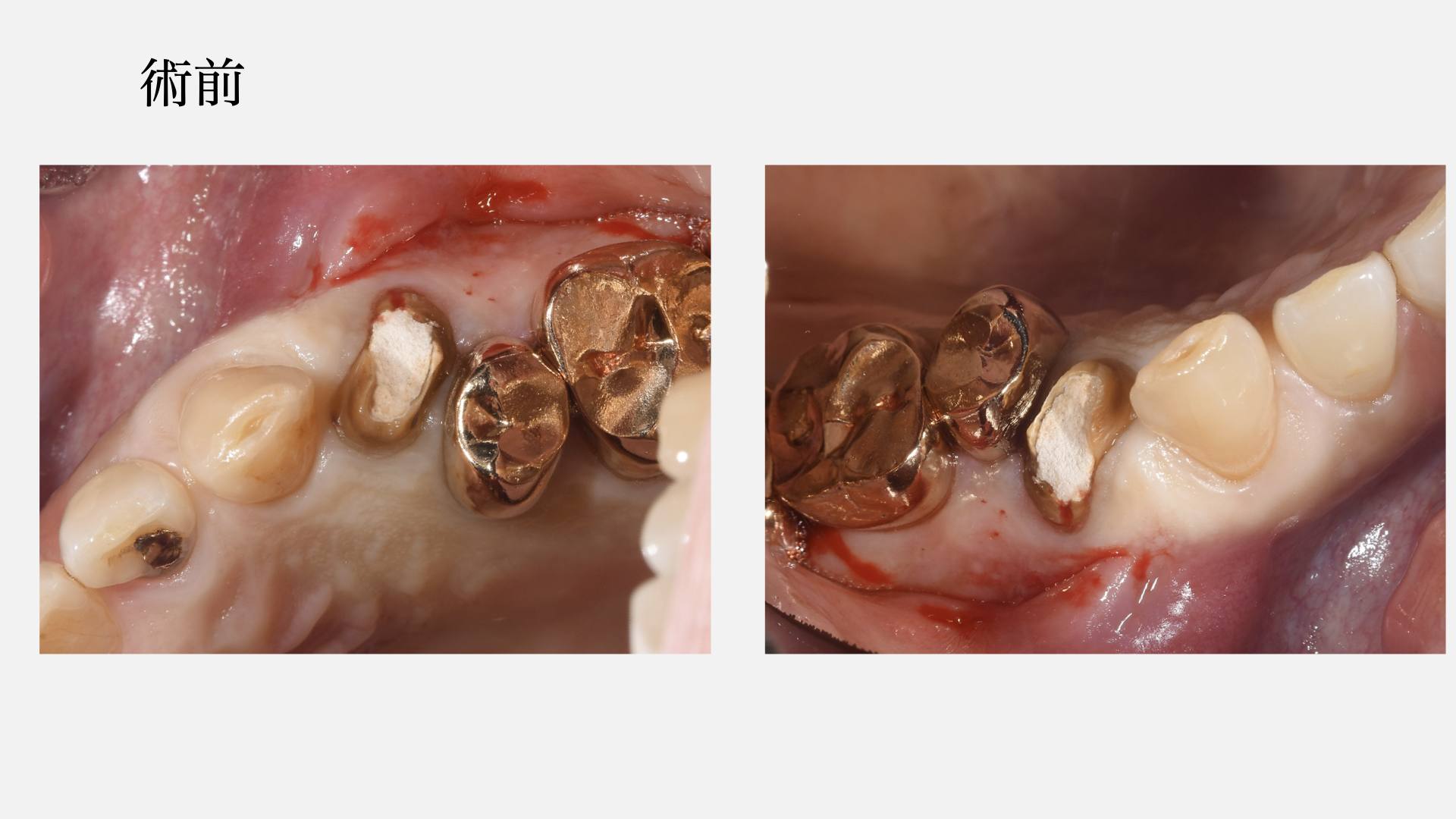 オープンメンブレンについて｜きたつじ歯科クリニック｜尼崎市武庫之荘