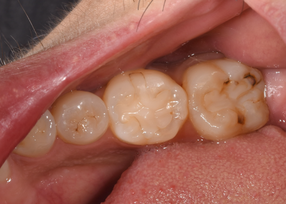 CR充填について｜きたつじ歯科クリニック｜尼崎市武庫之荘駅の歯科・歯医者