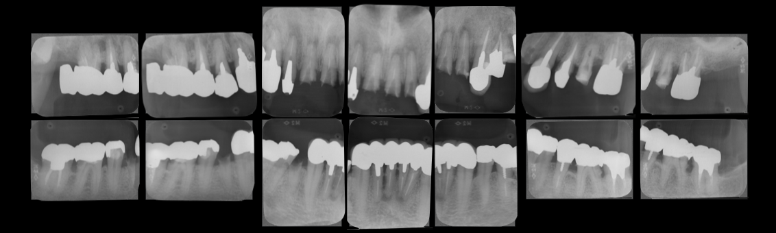 デンタルエックス線写真 各レントゲン写真の違いについて｜きたつじ歯科クリニック｜尼崎市武庫