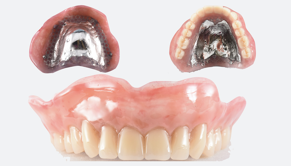 金属床義歯（上顎）
